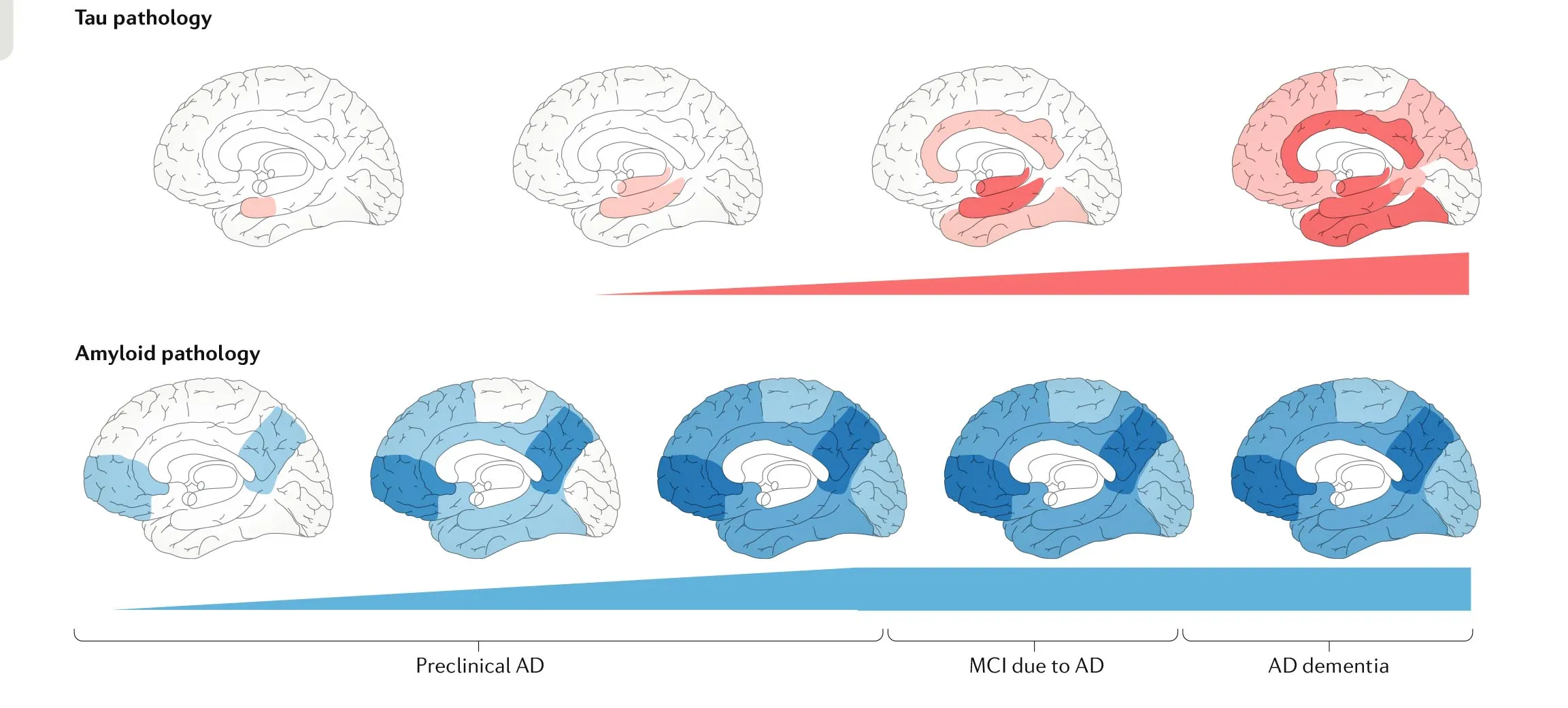 Progression of Aβ and tau pathology in AD, from an overview of data coming from PET and neuropathology studies. Notably, the initial accumulating regions are different, which may seem inconsistent with the cascade hypothesis. Original figure and adapted caption from van der Kant, Goldstein & Ossenkoppele, 2019.